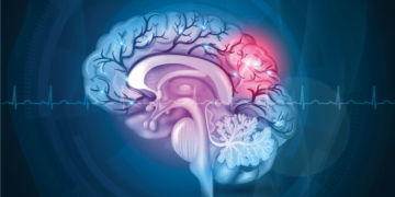 Accidentul vascular cerebral