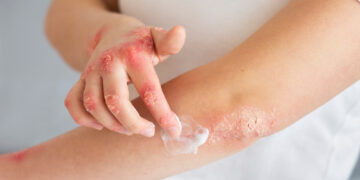 Dermatita