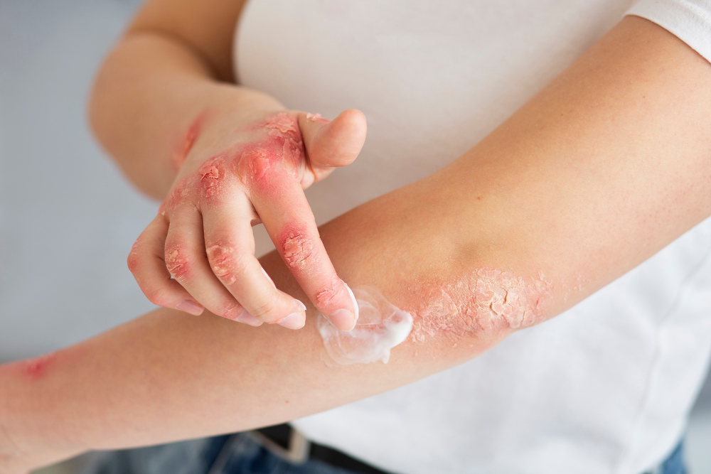Dermatita