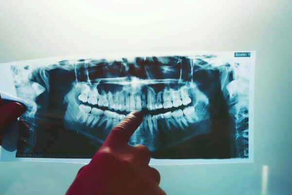 Sinus lift pentru implant dentar: ce este și când se recomandă