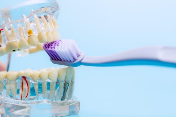 Cum îngrijești un implant dentar pentru a-l menține sănătos cât mai mult timp