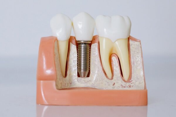 Model dentar cu implant între doi dinți naturali