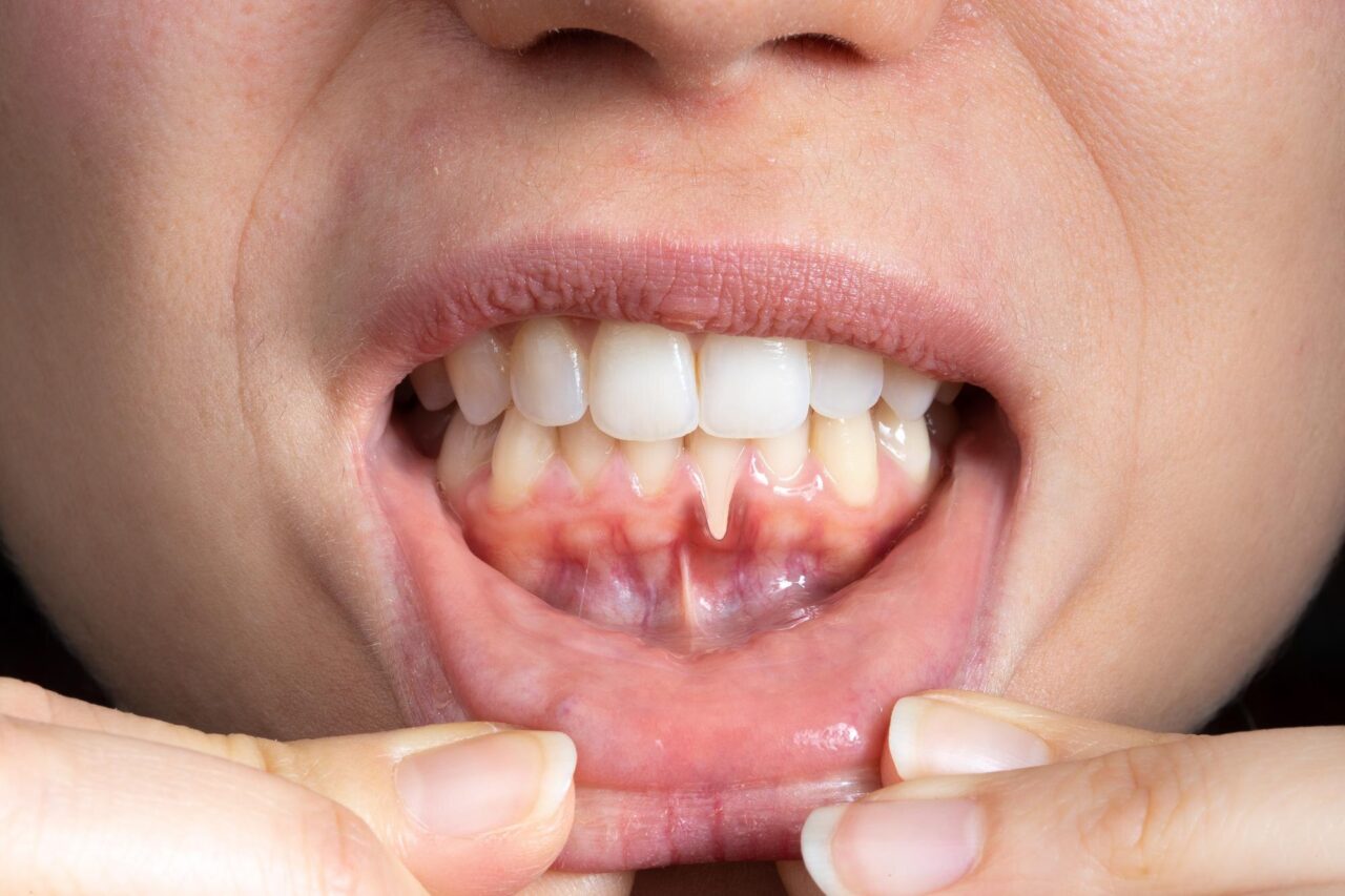 Retracția gingivală: de ce se retrag gingiile și ce opțiuni există