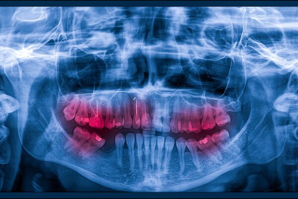 Chist dentar: simptome, cauze și opțiuni de tratament