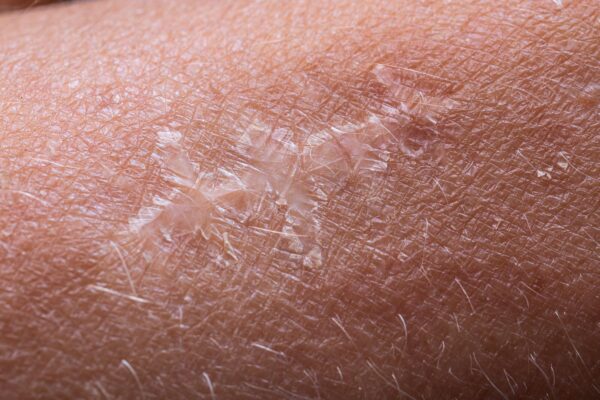 Dermatita seboreică a feței: de ce apar scuame lângă nas și sprâncene