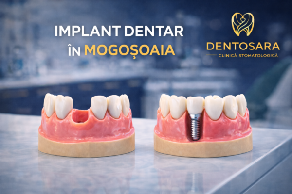 Beneficiile implantului dentar. De ce este o opțiune pentru înlocuirea dinților lipsă?
